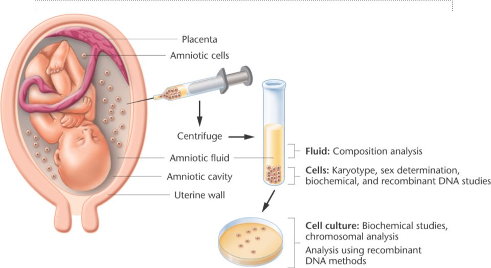 amniocentesis diagram